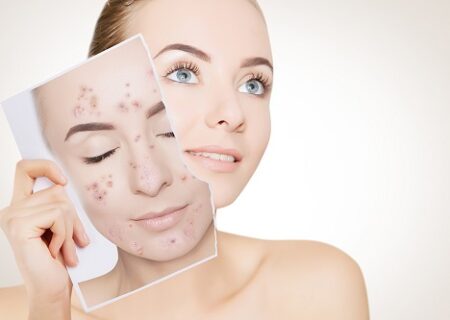 درمان فوری جوش صورت سه سوته