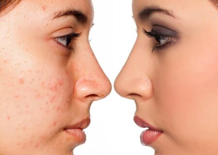جوش صورت و درمان جوش صورت در خانه