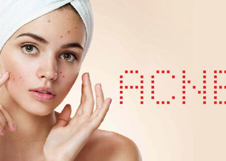 “درمان جوش صورت” سریعتر از آنچه فکر کنید