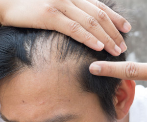 موهای نوجوان شما هم می ریزد ؟