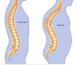 چند تمرین ساده برای رفع قوز کمر + آموزش